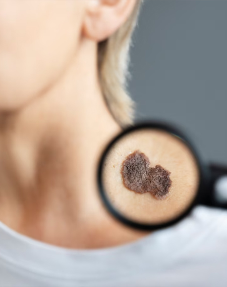 Moles-and-Skin